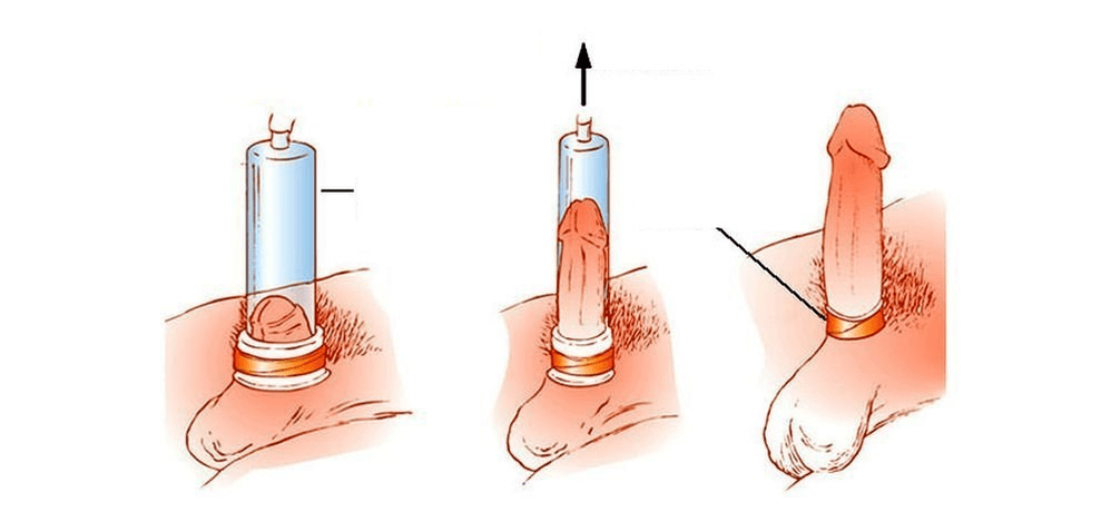 hvordan en vakuumpumpe til penisforstørrelse fungerer