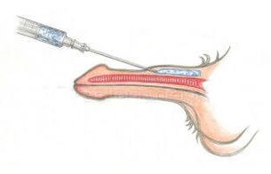 Injicering af hyaluronsyre under huden for at gøre penis tykkere