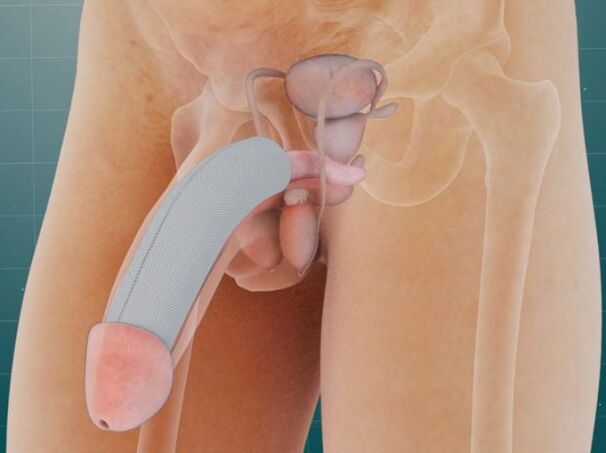 Penis efter indførelsen af ​​et specielt implantat under huden