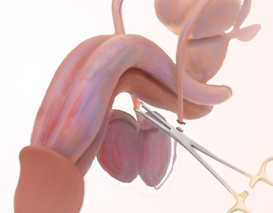 ligamentotomi til penisforstørrelse